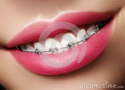 Beautiful White Teeth with Braces. Dental Care Photo. Woman Smile with Ortodontic Accessories. Orthodontics Treatment Stock Photo