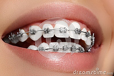 Beautiful white teeth with braces. Dental care photo. Woman smile with ortodontic accessories. Orthodontics treatment Stock Photo