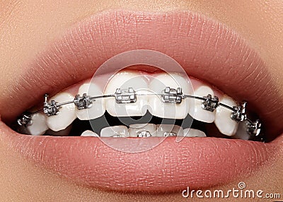 Beautiful white teeth with braces. Dental care photo. Woman smile with ortodontic accessories. Orthodontics treatment Stock Photo