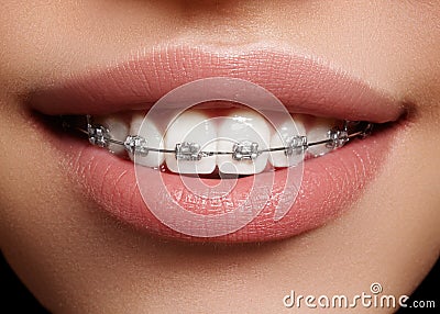 Beautiful white teeth with braces. Dental care photo. Woman smile with ortodontic accessories. Orthodontics treatment Stock Photo