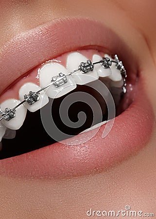 Beautiful white teeth with braces. Dental care photo. Woman smile with ortodontic accessories. Orthodontics treatment Stock Photo