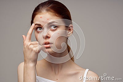 beautiful woman with pimples on the face hygiene isolated background Stock Photo