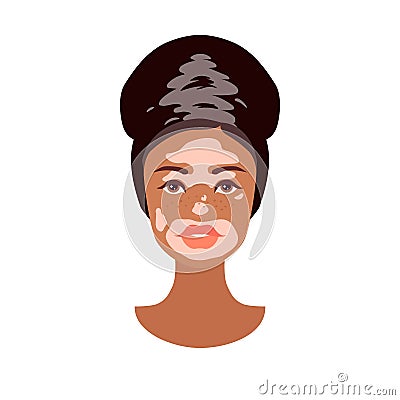Beautiful young African woman face with Vitiligo disorder texture. Skin condition that causes loss of melanin. Ð¡ute girl head. Vector Illustration