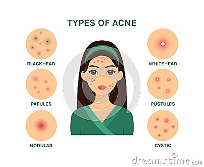 Beautiful Young Woman and Types of Acne. Isolated Teenager Girl with a Bad Problem Skin of Face. Infection, Rash and Redness on Vector Illustration