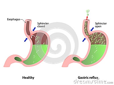 Belching, Heartburn or reflux Vector Illustration