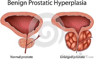 Benign Prostatic Hyperplasia Vector Illustration