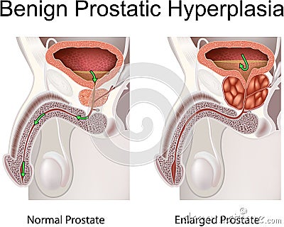 Benign Prostatic Hyperplasia Vector Illustration