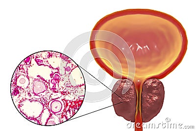 Benign prostatic hyperplasia Cartoon Illustration