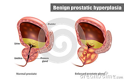 Benign prostatic hyperplasia BPH Vector Illustration