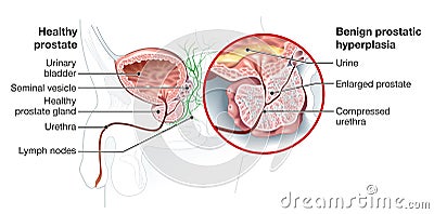 Benign prostatic hyperplasia BPH, enlarged prostate with bladder, urethra and seminal vesicle, medical illustration Stock Photo