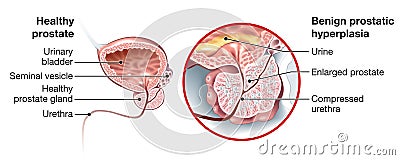 Benign prostatic hyperplasia BPH, enlarged prostate with bladder, urethra and seminal vesicle, medical illustration Stock Photo