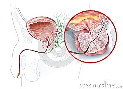 Benign prostatic hyperplasia BPH, enlarged prostate with bladder, urethra and seminal vesicle, medical illustration Stock Photo