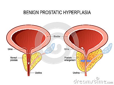 Benign prostatic hyperplasia BPH. prostate enlargement Vector Illustration