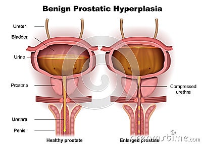 Benign prostatic hyperplasia 3d medical illustration Cartoon Illustration
