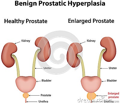 Benign Prostatic Hyperplasia Vector Illustration