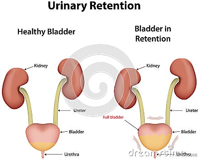 Benign Prostatic Hyperplasia Vector Illustration