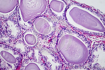 Benign prostatic hyperplasia, light micrograph Stock Photo