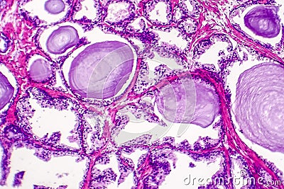 Benign prostatic hyperplasia Stock Photo