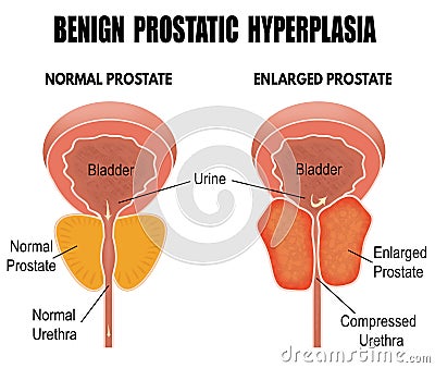 Benign prostatic hyperplasia Vector Illustration