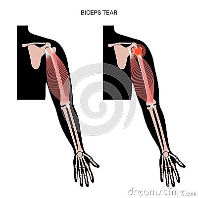 Biceps tear trauma Vector Illustration