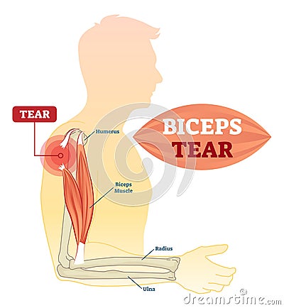 Biceps tear vector illustration. Labeled medical scheme with humerus, muscle, radius and ulna isolated closeup. Anatomical diagram Vector Illustration