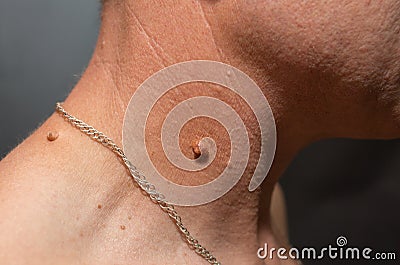 Big birthmark on the man` skin. Medical health papilloma photo Stock Photo