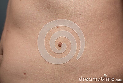 Big birthmark on the man` skin. Medical health papilloma photo Stock Photo