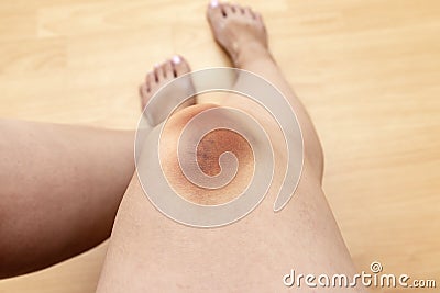 A big bruise, hematoma extravasation on female leg, knee injury Stock Photo