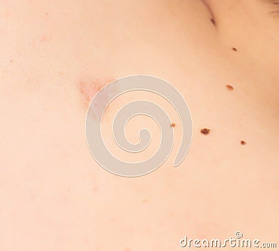 Big scar and moles on the skin of a person on the back, copy space, dermatology Stock Photo