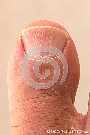 Big Toe with Ingrown Toenail Stock Photo