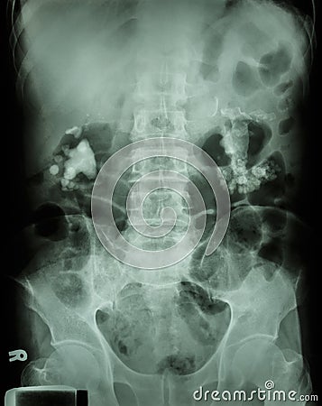 Bilateral renal calculi (staghorn) Stock Photo