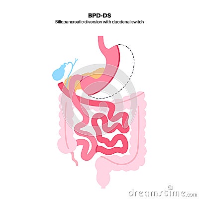 Biliopancreatic diversion procedure Vector Illustration