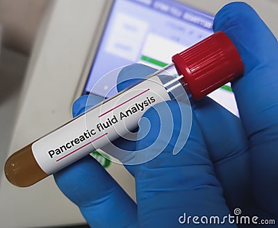 Biochemist or medical technologist hold Pancreatic cyst fluid analysis sample, Ascites Stock Photo