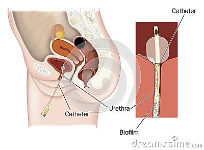 Biofilm formation on catheter Stock Photo
