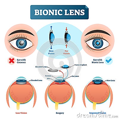 Bionic lens vector illustration. Eye lens structure labeled scheme. Vector Illustration