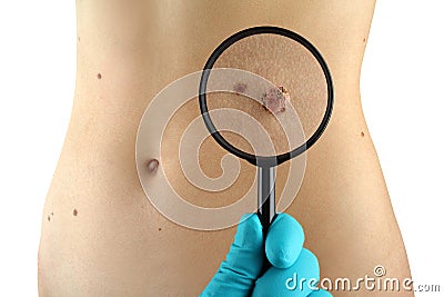 Birthmark. Dermatologist examines mole. Stock Photo