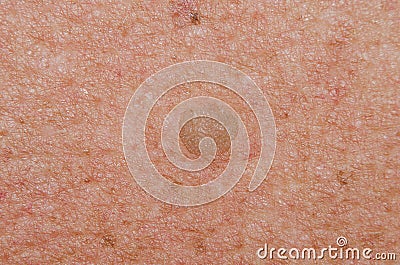 Birthmark of keratoma on the skin of an old mans body close-up Stock Photo