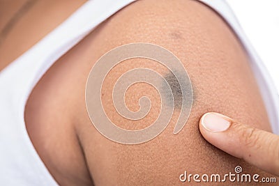 Birthmark on skin Stock Photo