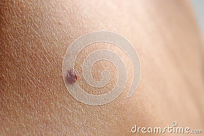 Birthmark, skin spot Stock Photo