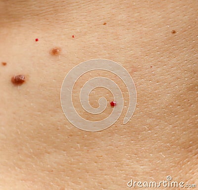 Birthmarks on the skin as a background Stock Photo