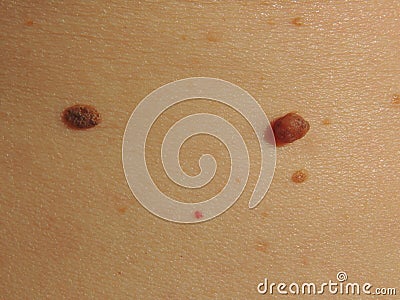 Birthmarks on the skin Stock Photo