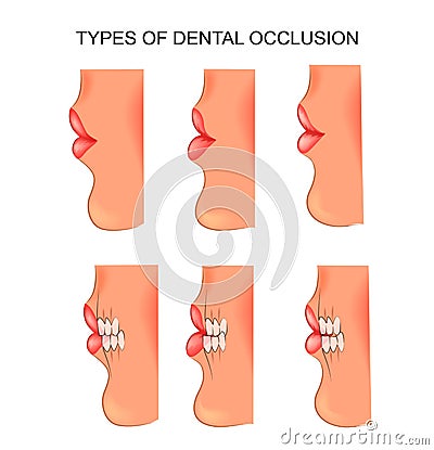 Bite dental. dentistry Vector Illustration