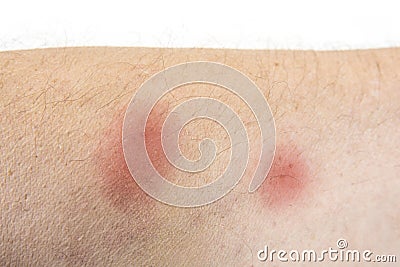 Bites of insect on male body. Bed bugs or flea Stock Photo