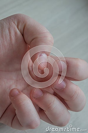 Bitten fingernails damaged due to anxiety disorders with damaged cuticles from skin picking. Conceptual for stress, depression or Stock Photo