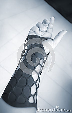 Black orthopedic plastic prosthesis printed on 3D printer on hand. Stock Photo