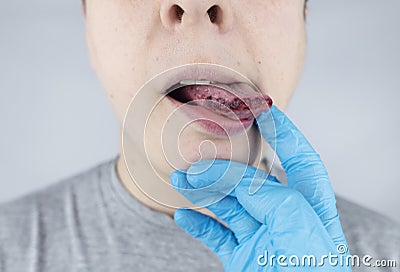 Black tongue. A man shows the consequences of an injury, bite or burn of the tongue. Part is damaged. Treatment of internal Stock Photo