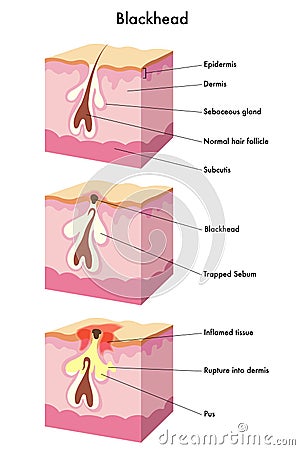 Blackhead Vector Illustration