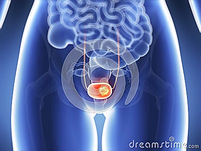 Bladder cancer Cartoon Illustration