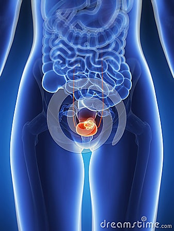 Bladder cancer Cartoon Illustration