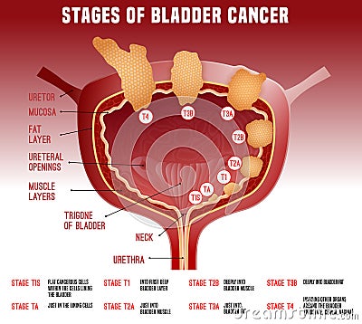 Bladder Cancer Image Vector Illustration